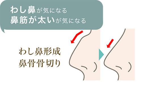 わし鼻が気になる鼻筋が太いが気になる