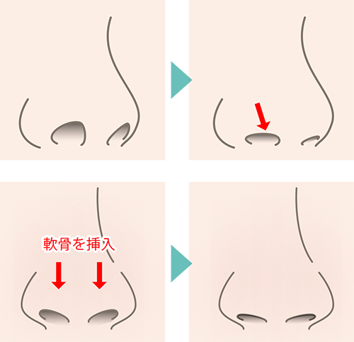 鼻孔縁下降