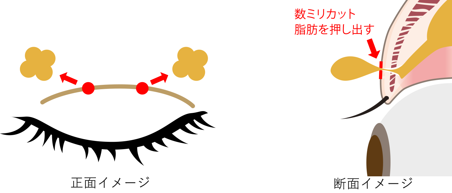 脂肪取り併用埋没法とは