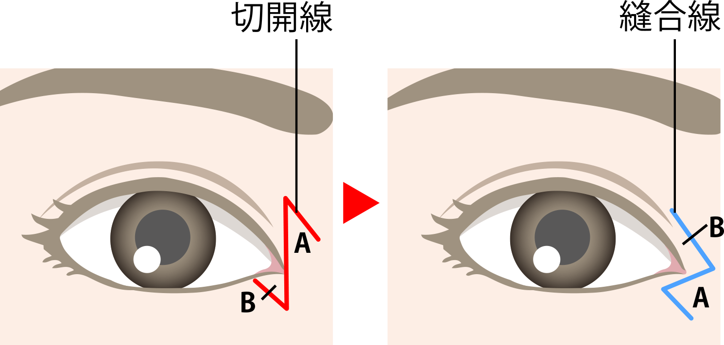 目頭切開の手術方法