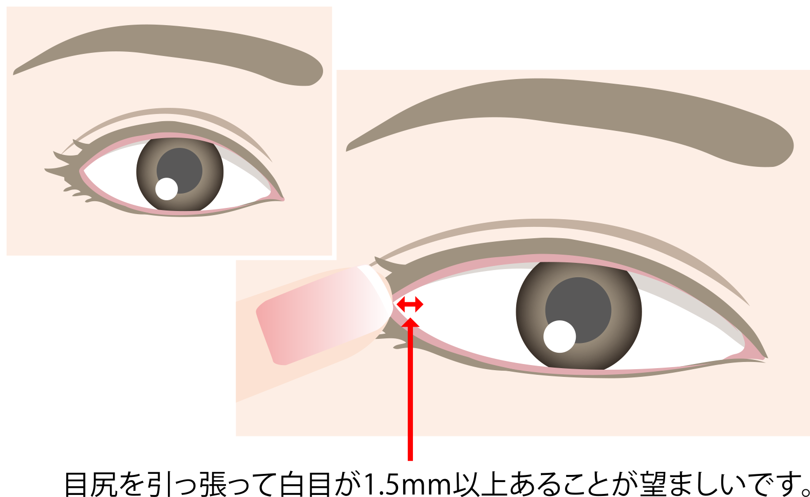 目尻切開に向いている方