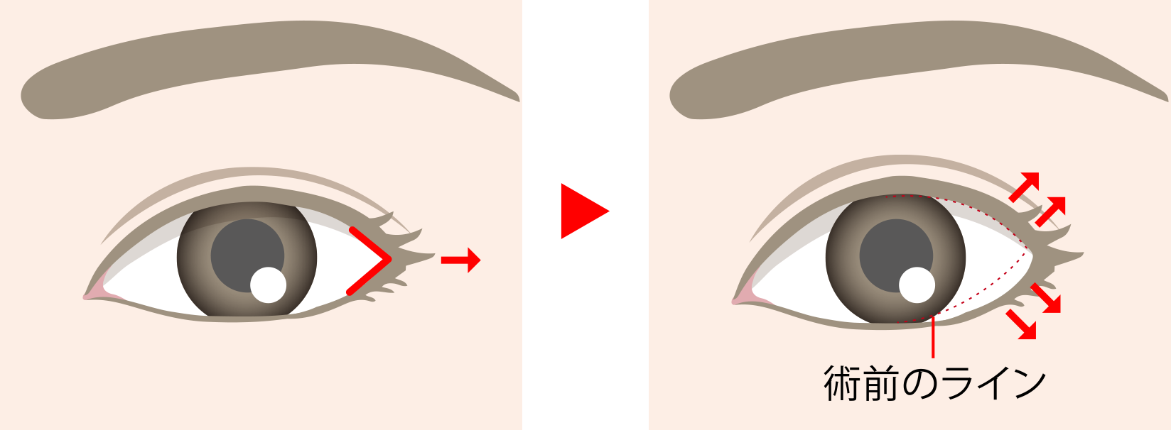 目尻切開の手術方法