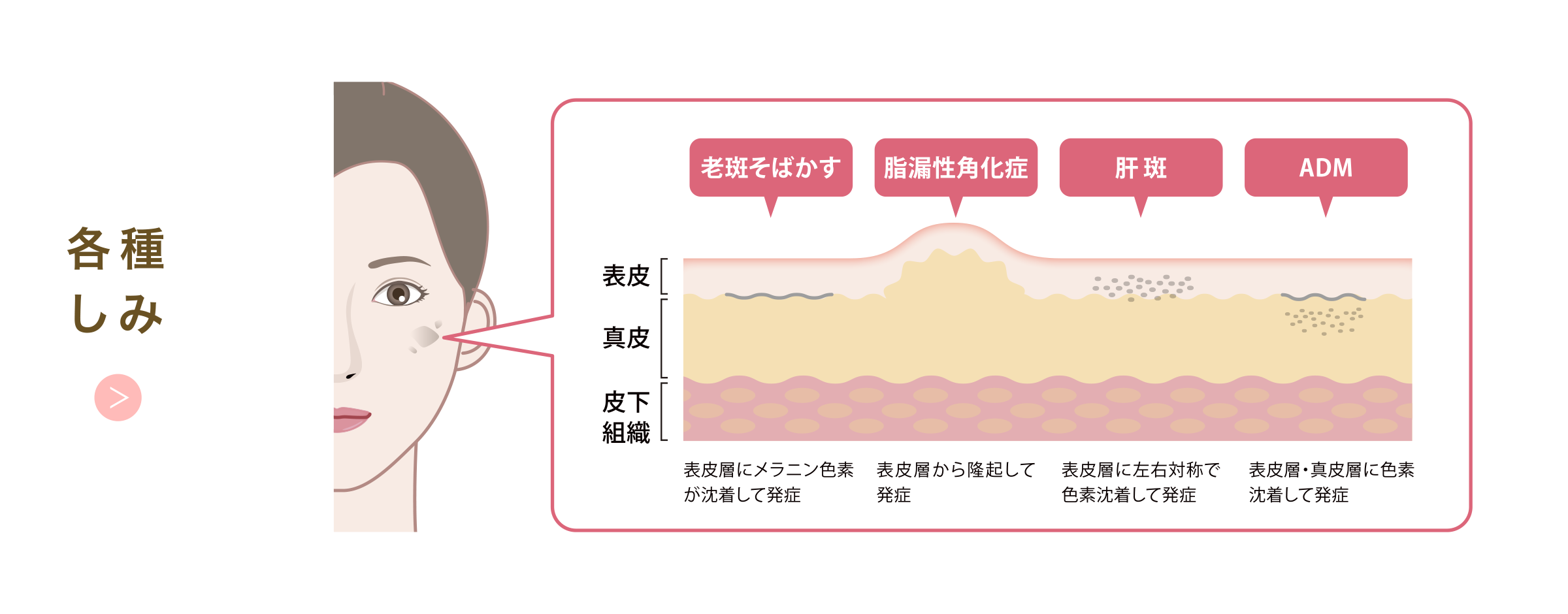 各種しみ