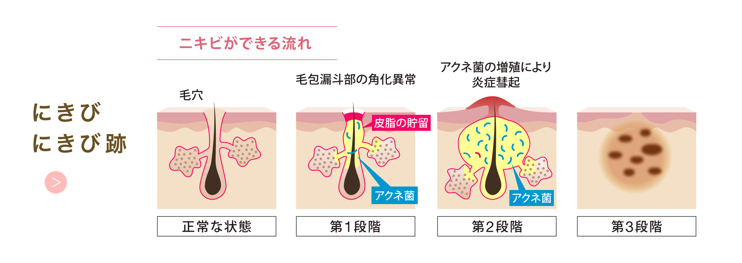 にきび・にきび跡