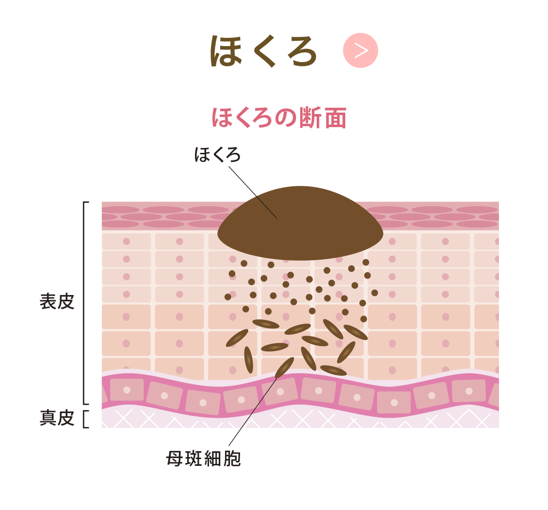 ほくろ