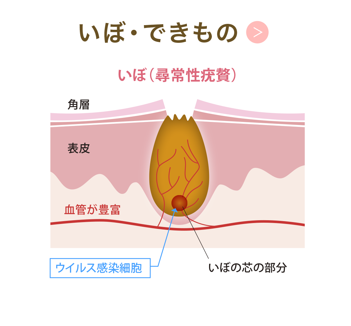 いぼ・できもの