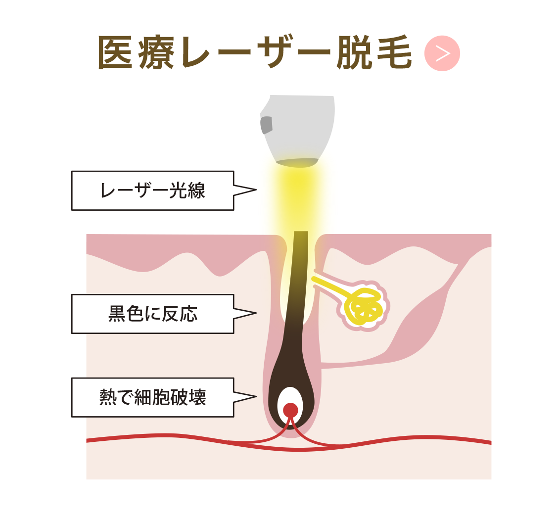 医療レーザー脱毛