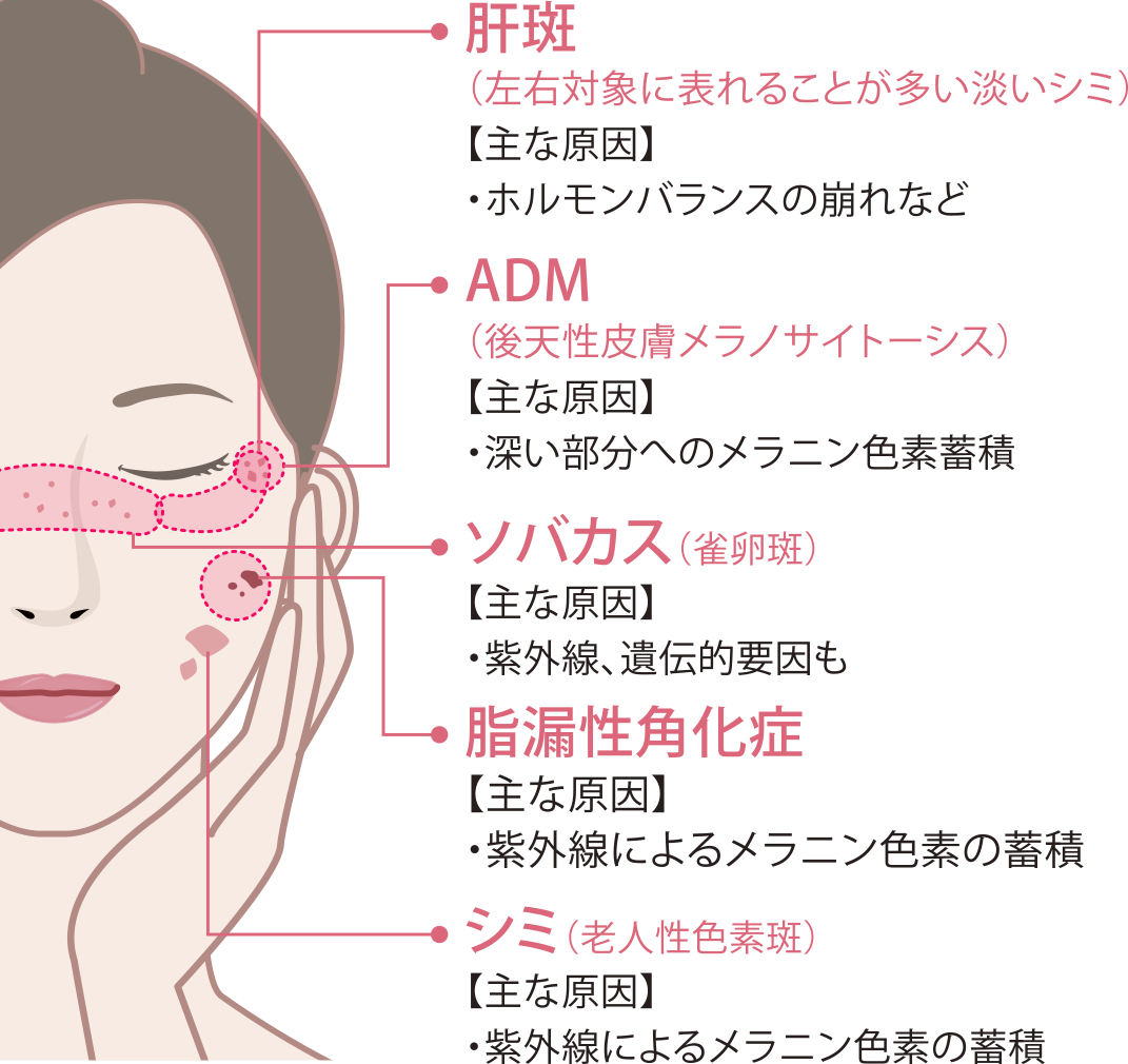 そばかすなどの各種しみ