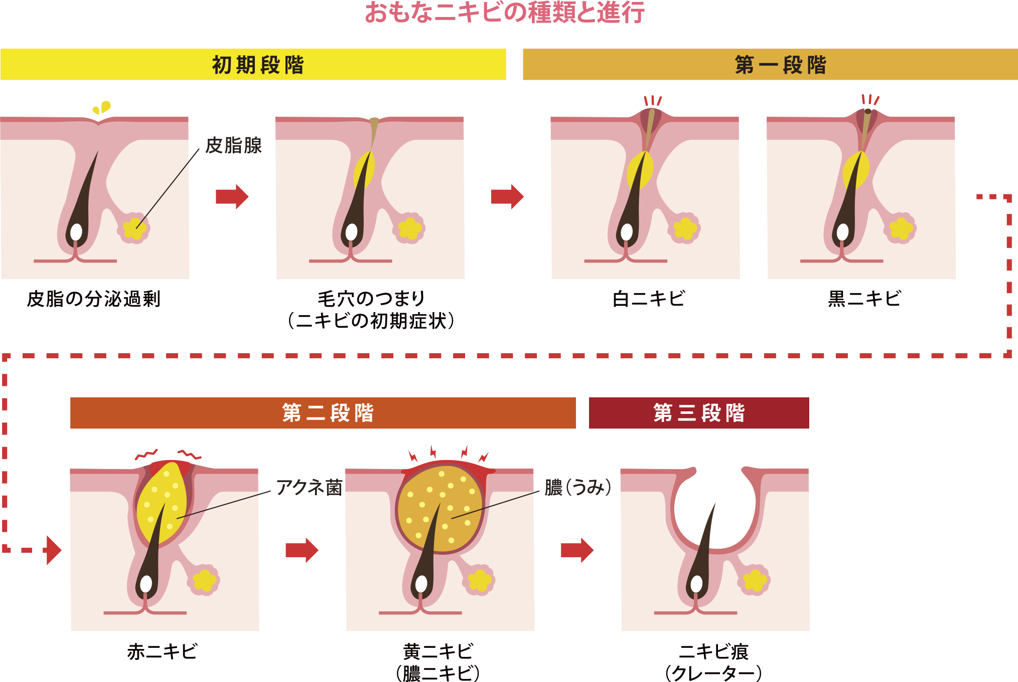 ニキビの進行