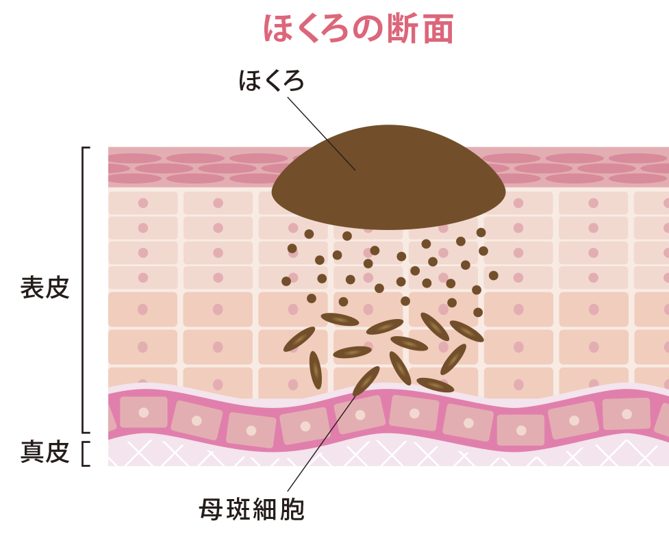 ほくろ