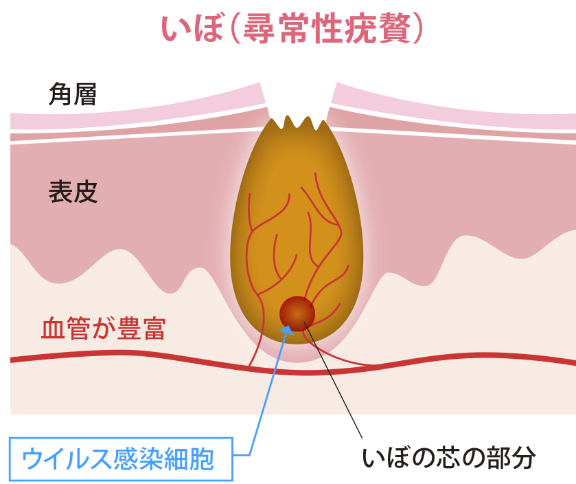ほくろ