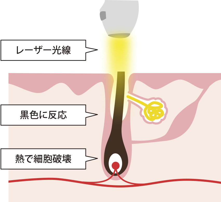 医療レーザー脱毛
