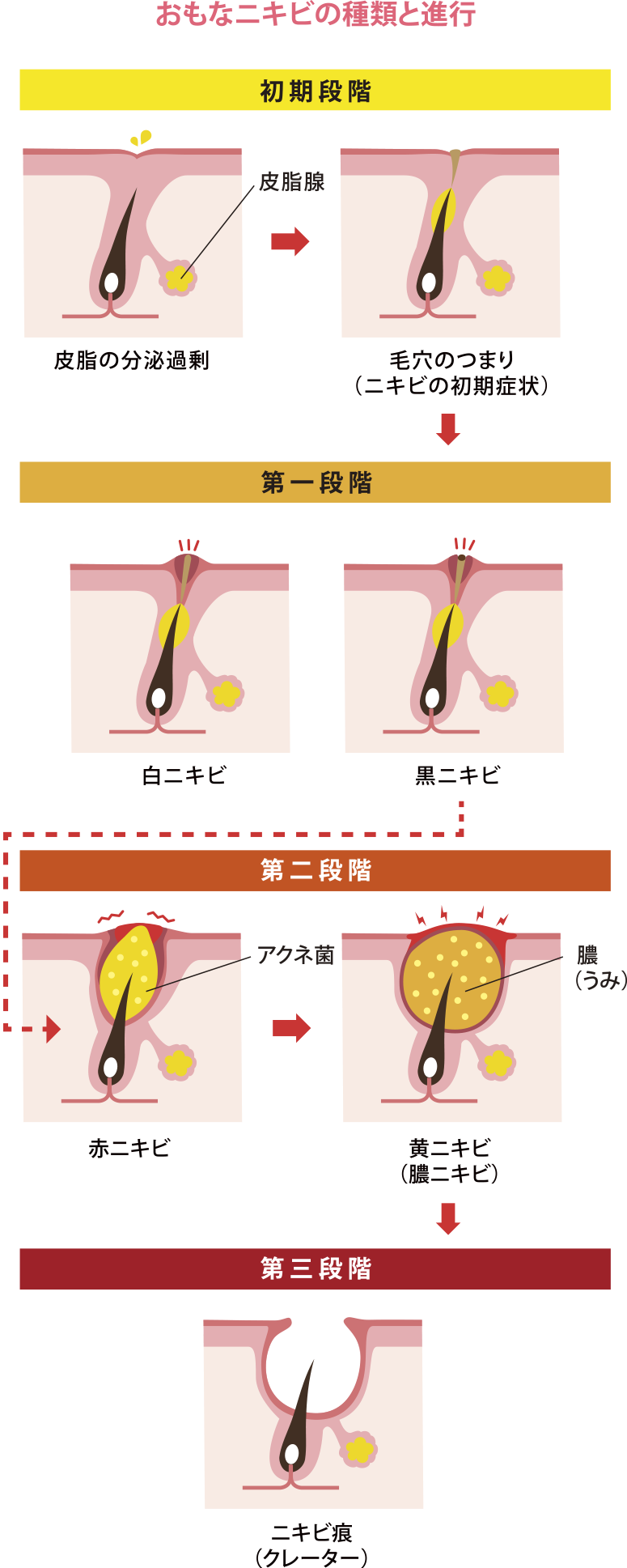 ニキビの進行