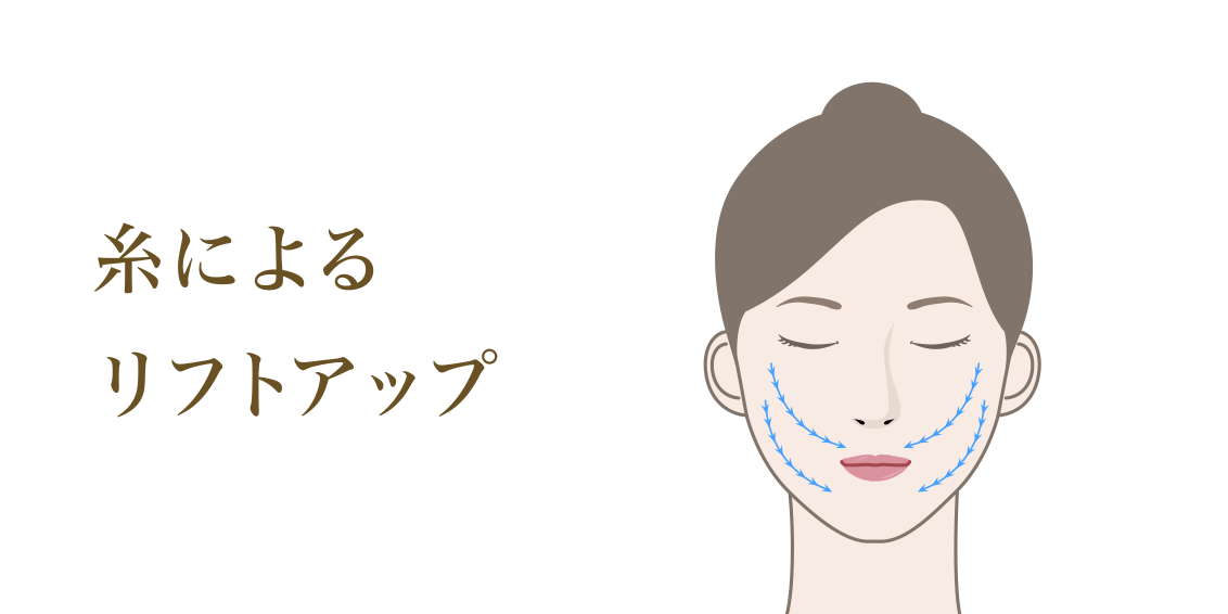 糸によるリフトアップ
