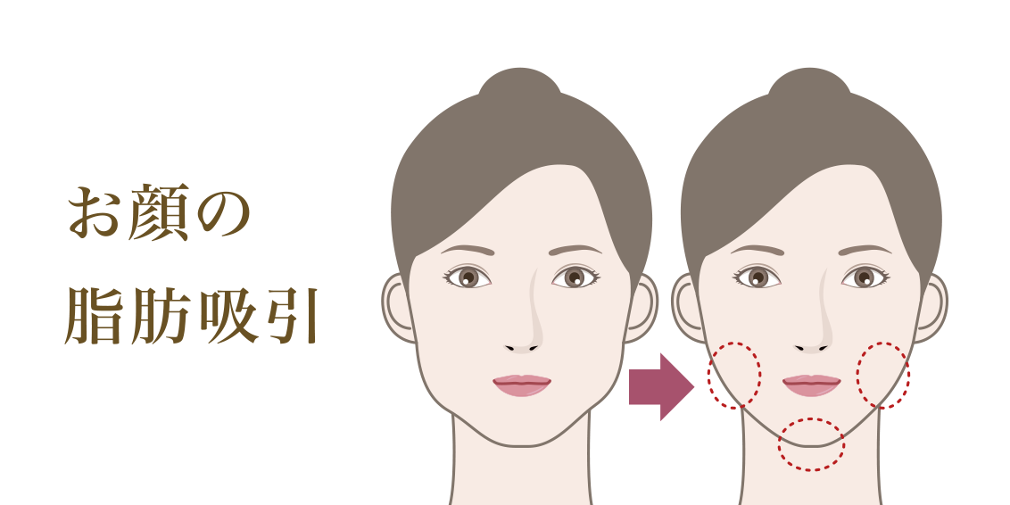 お顔の脂肪吸引