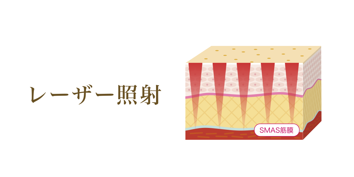 レーザー照射