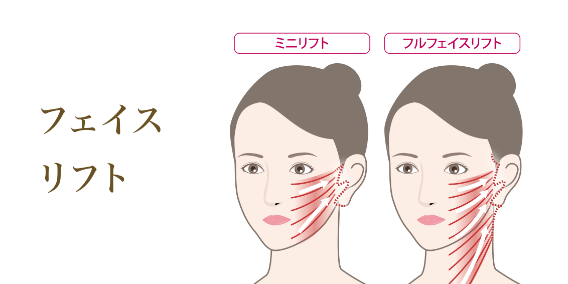 フェイスリフト