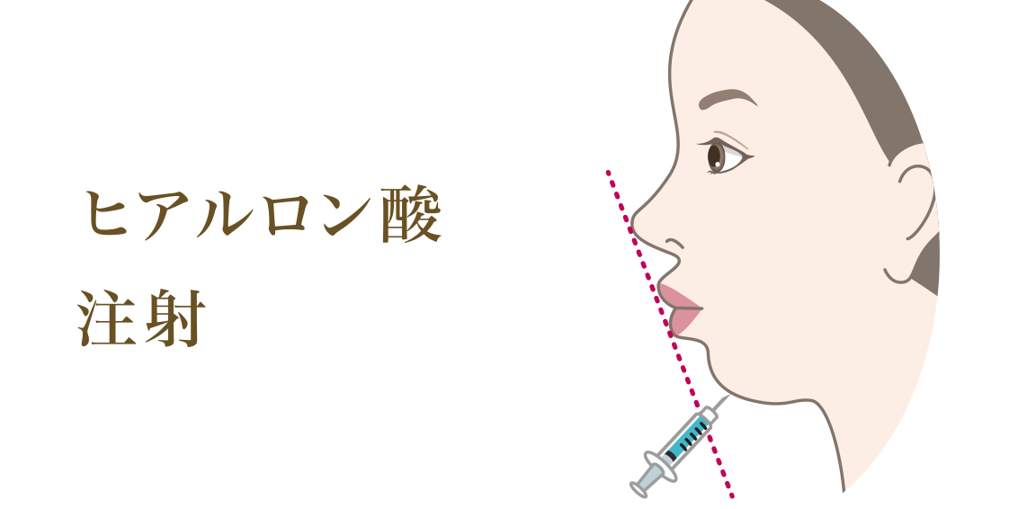 ヒアルロン酸注射