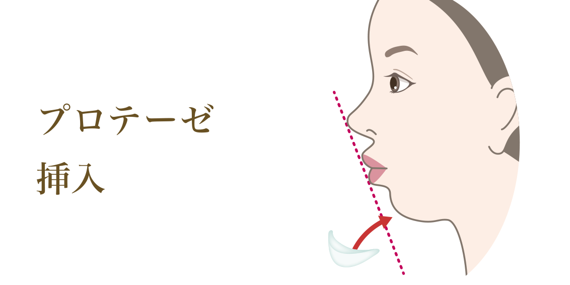 プロテーゼ挿入