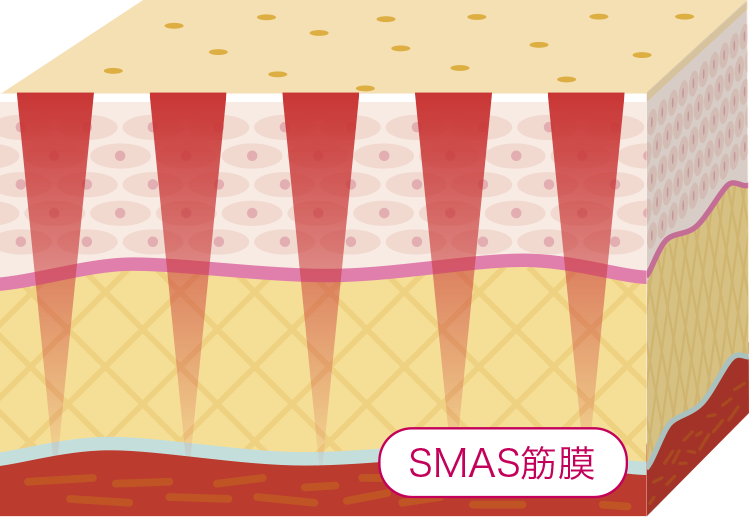 レーザー照射