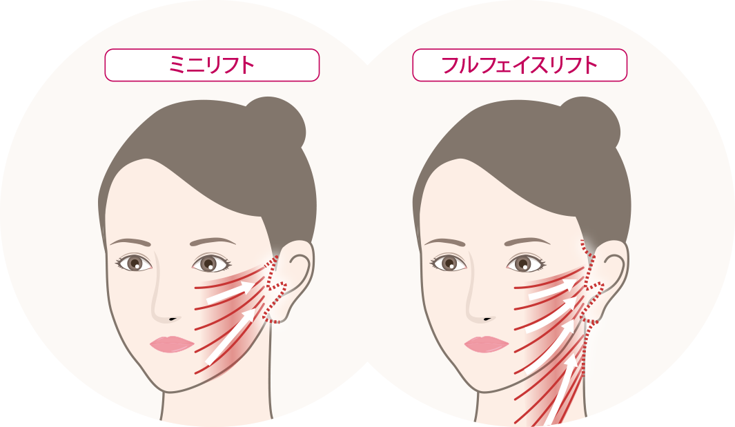 フェイスリフト