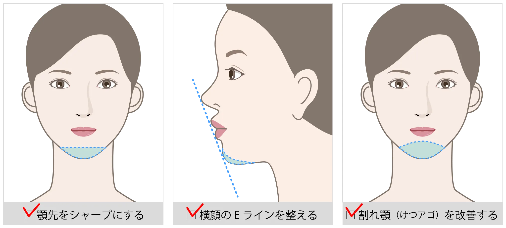jaw_formation