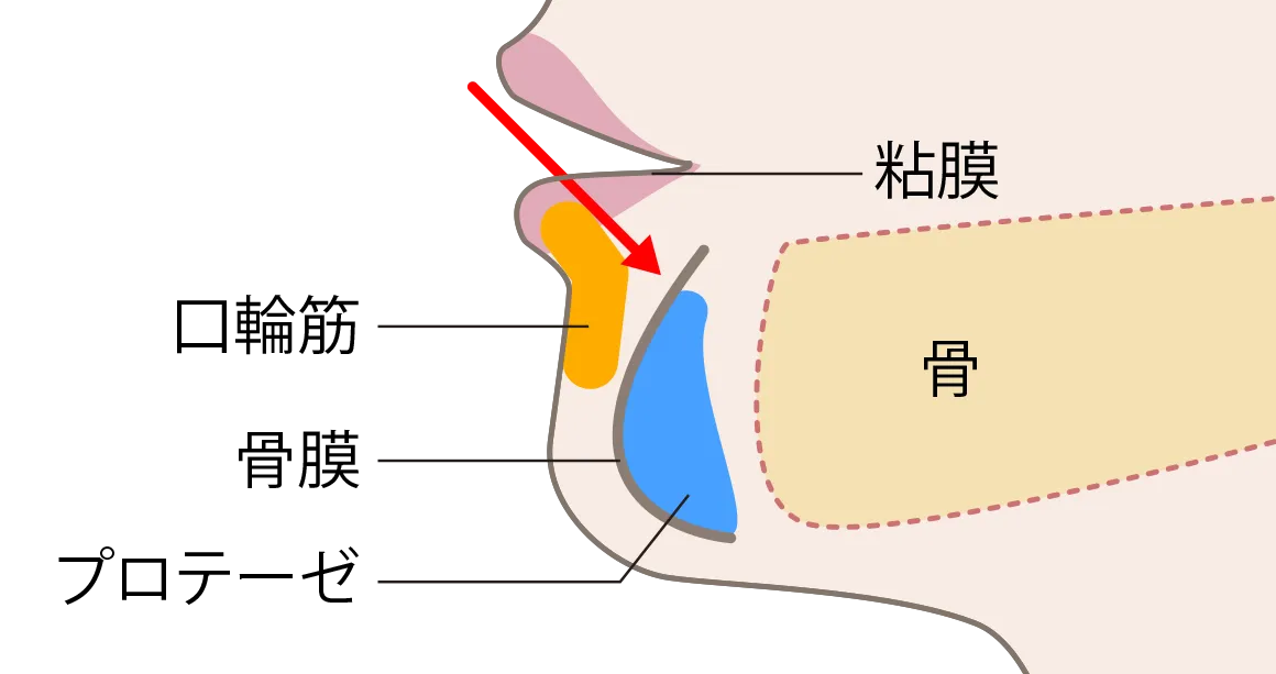 jaw_prosthesis_method