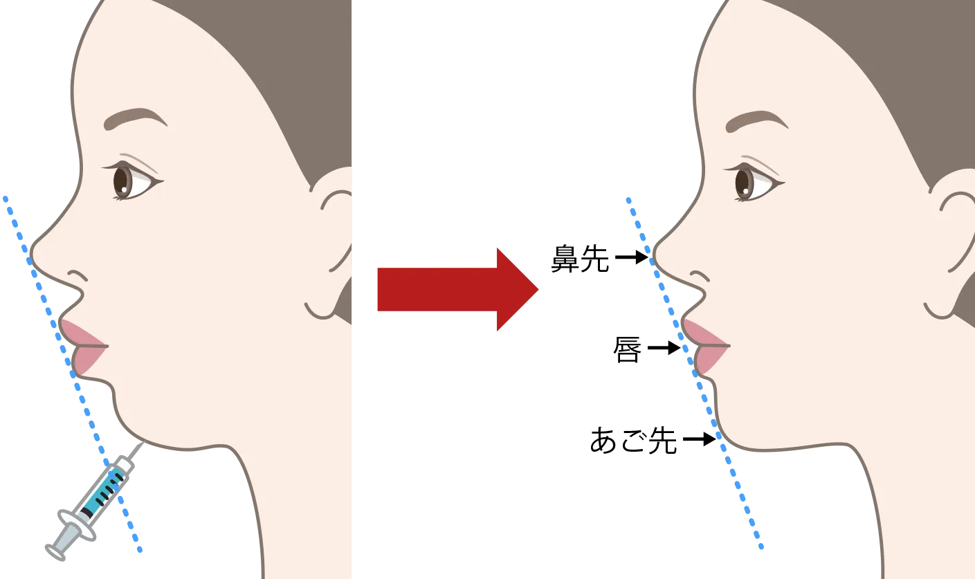 jaw_hyaluronic_acid