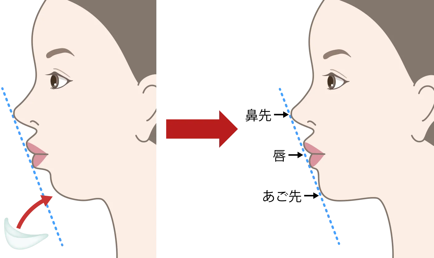 jaw_prosthesis