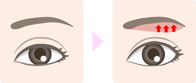 眉下切開イメージ