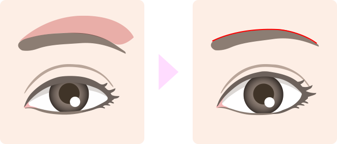 ブローリフトイメージ