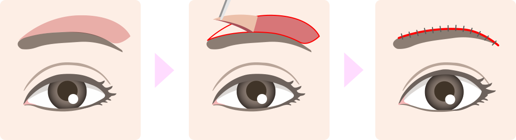 ブローリフト施術方法