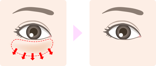 表ハムラ法イメージ