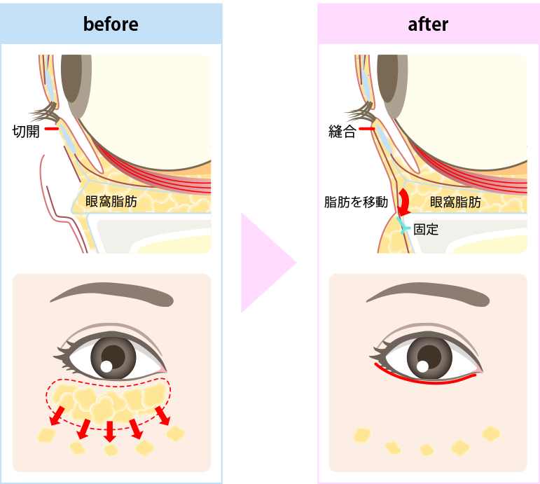表ハムラ法施術方法