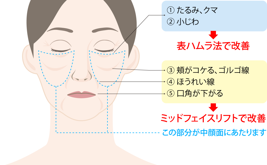 ミッドフェイスリフトとの併用